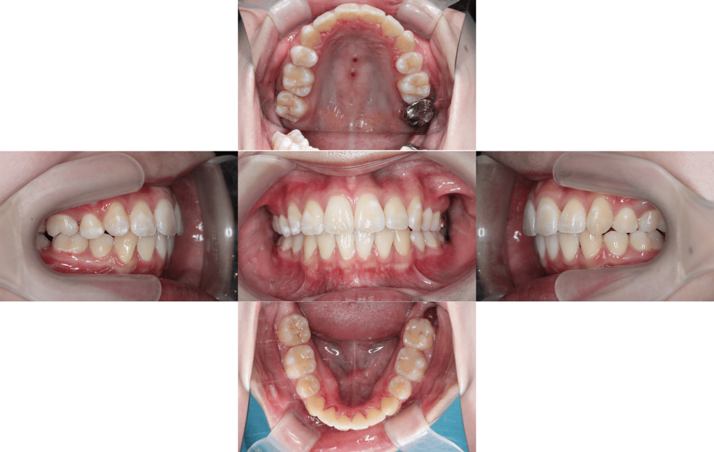 裏側矯正　叢生症例