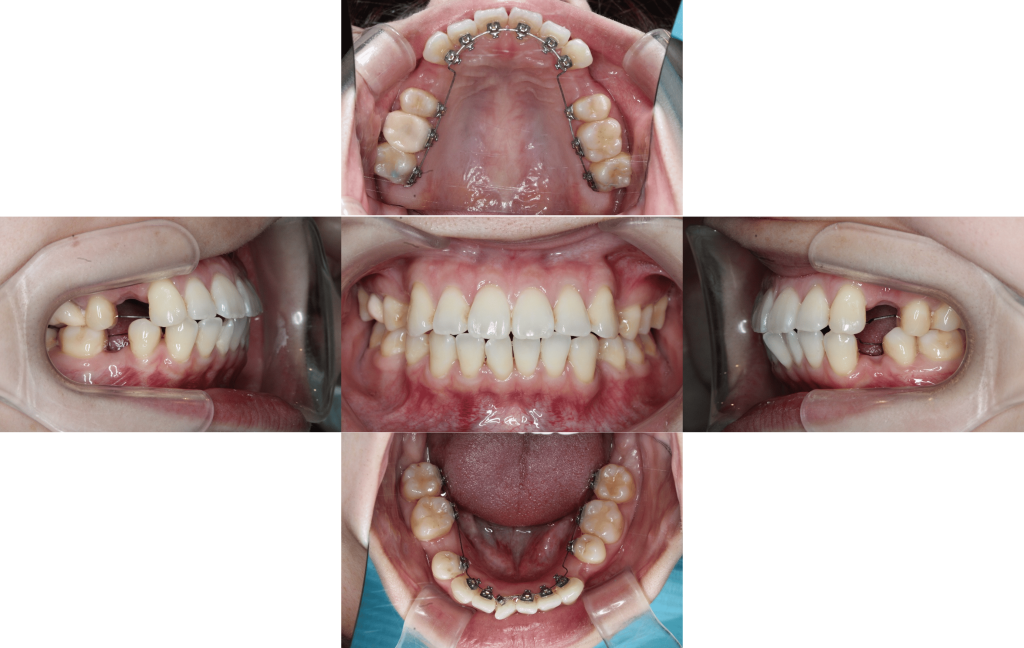 裏側矯正　叢生上顎前突症例