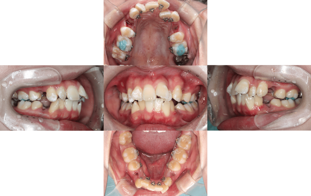 裏側矯正　叢生症例