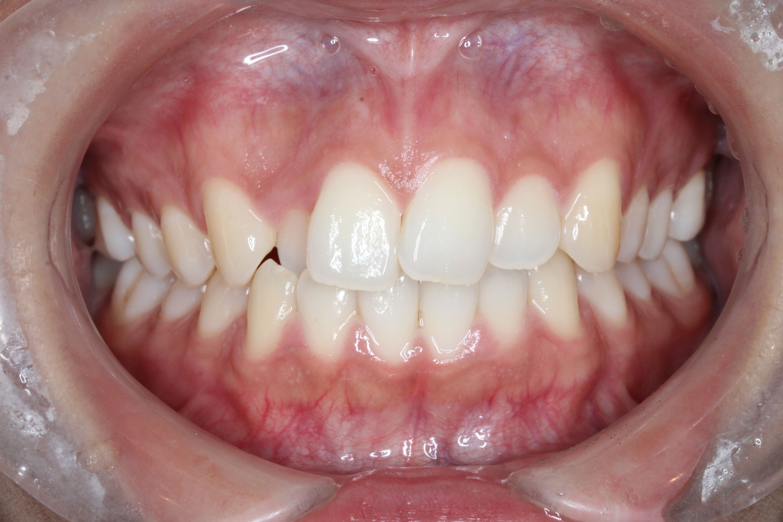 裏側矯正　叢生症例