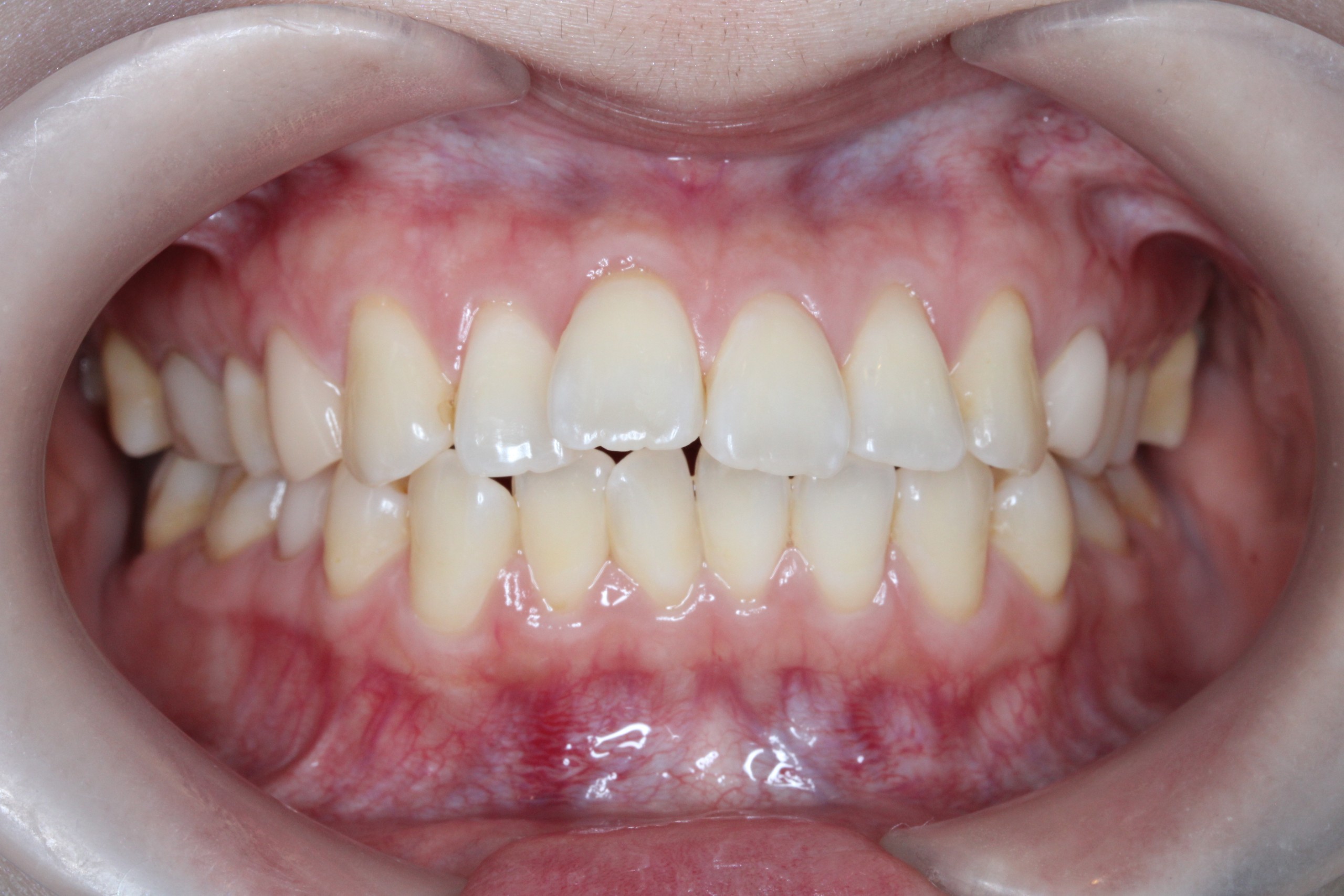 裏側矯正　叢生上顎前突症例