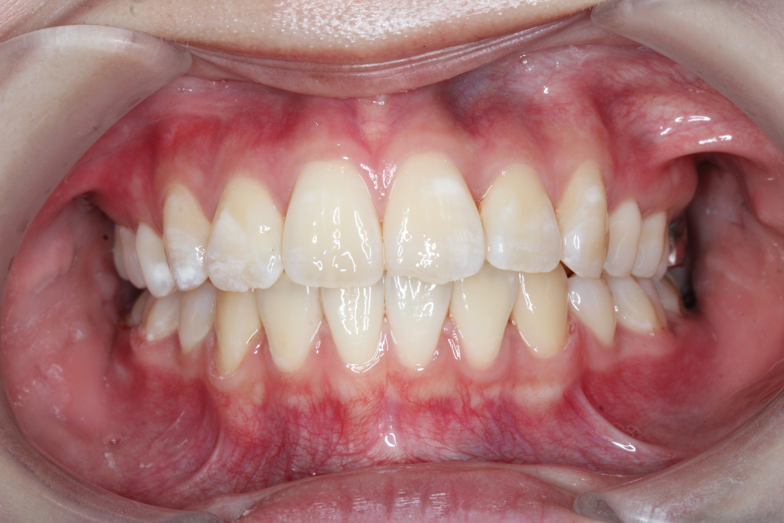 裏側矯正　叢生症例