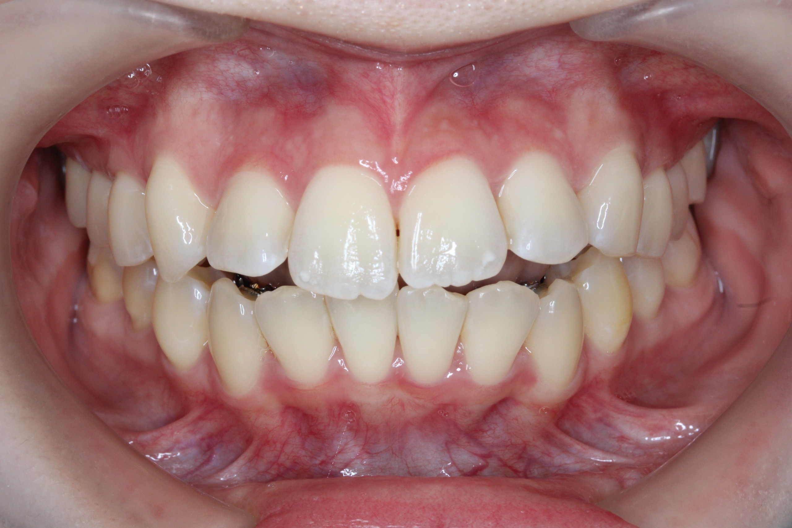 叢生・裏側矯正の症例