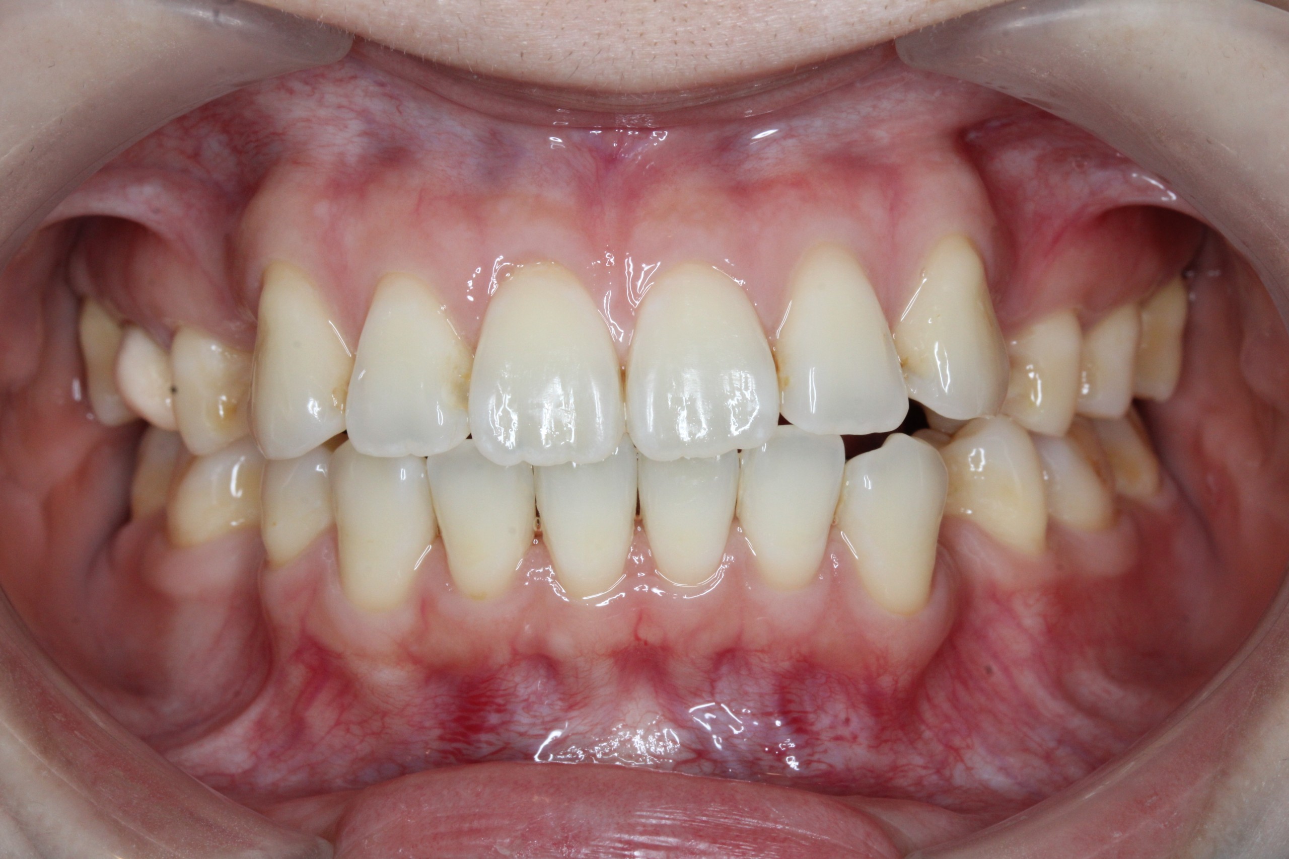 裏側矯正　叢生上顎前突症例