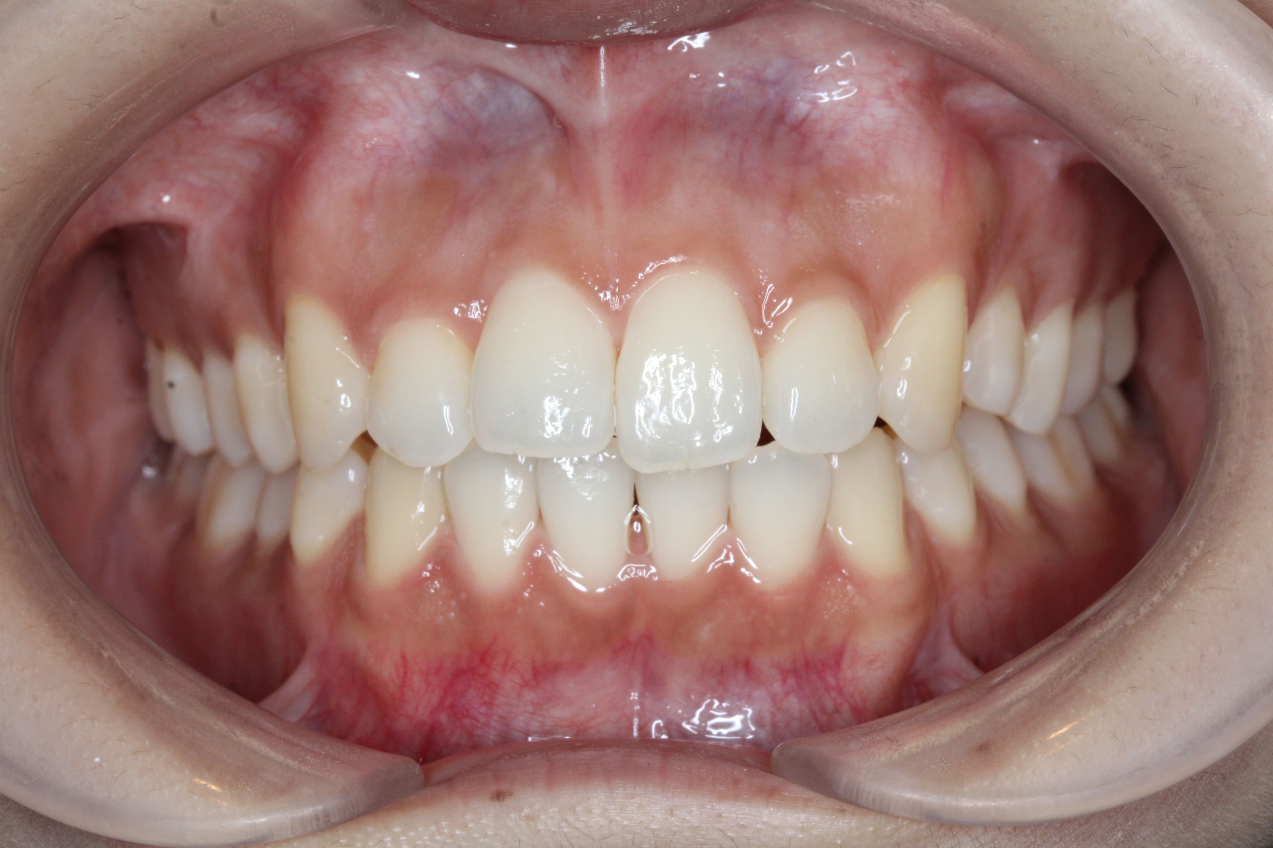 裏側矯正　叢生症例