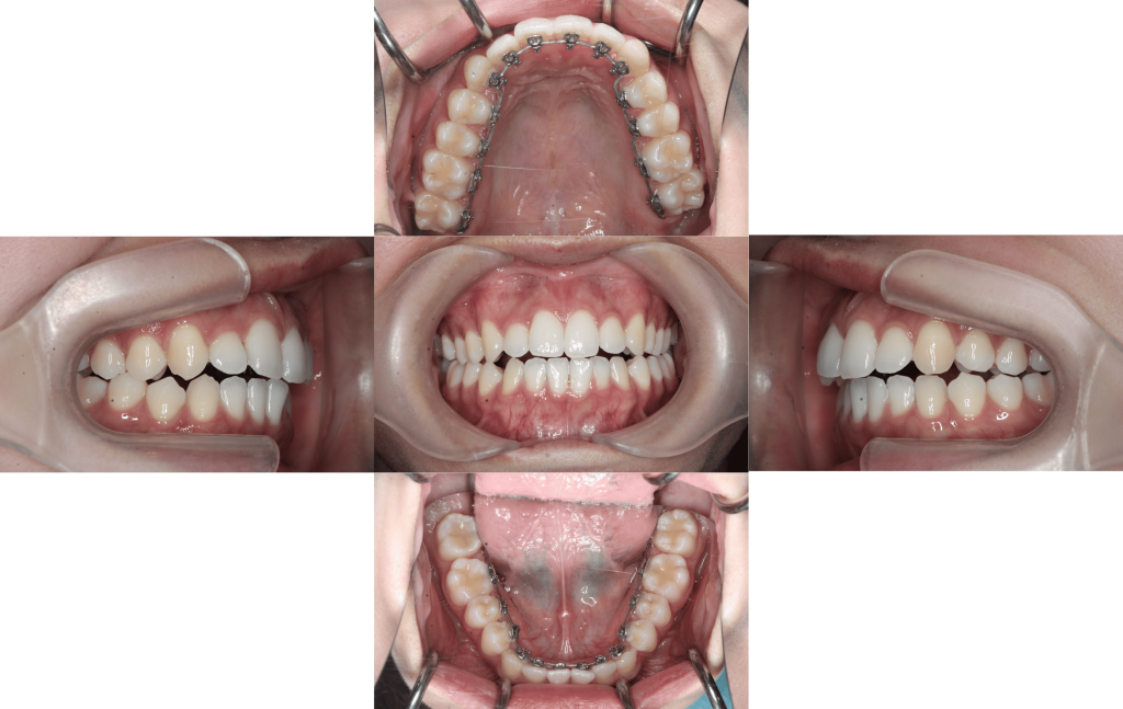 裏側矯正　叢生症例