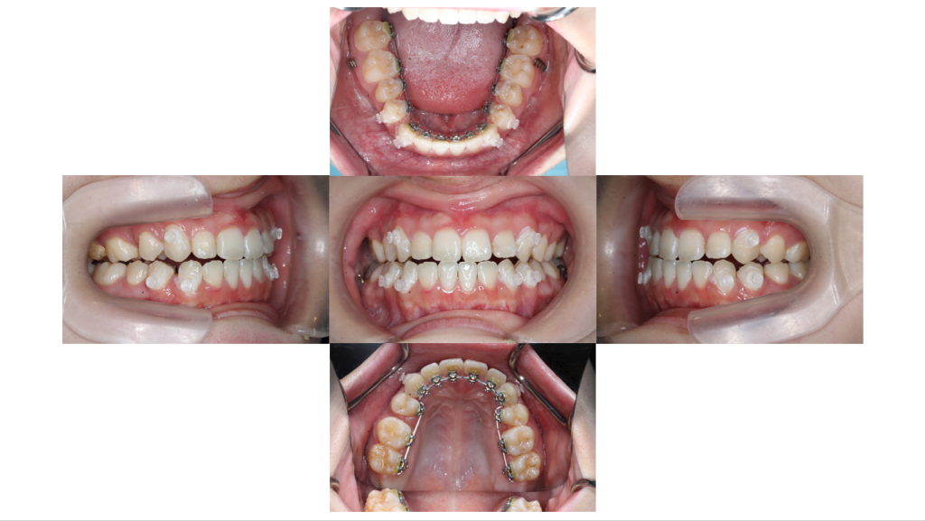 受け口・サージェリーファーストの症例