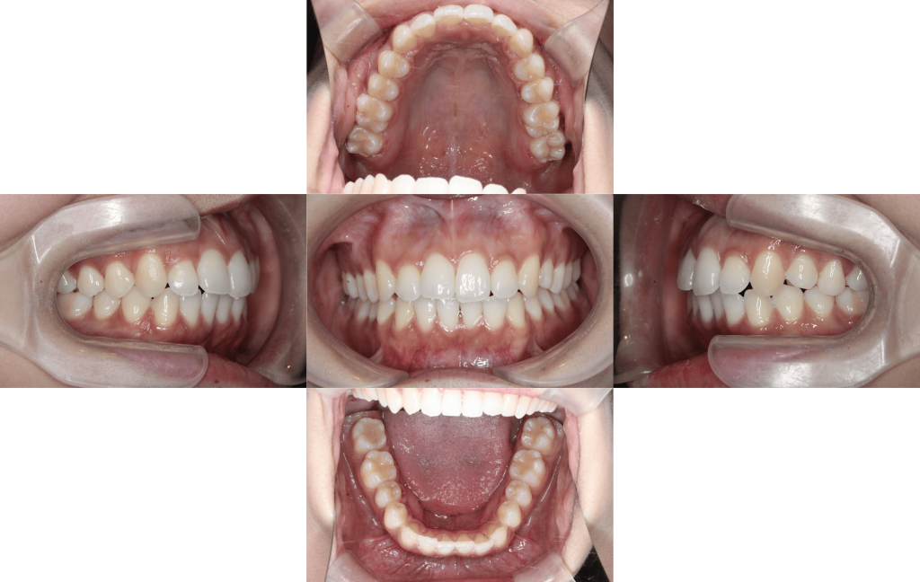 裏側矯正　叢生症例