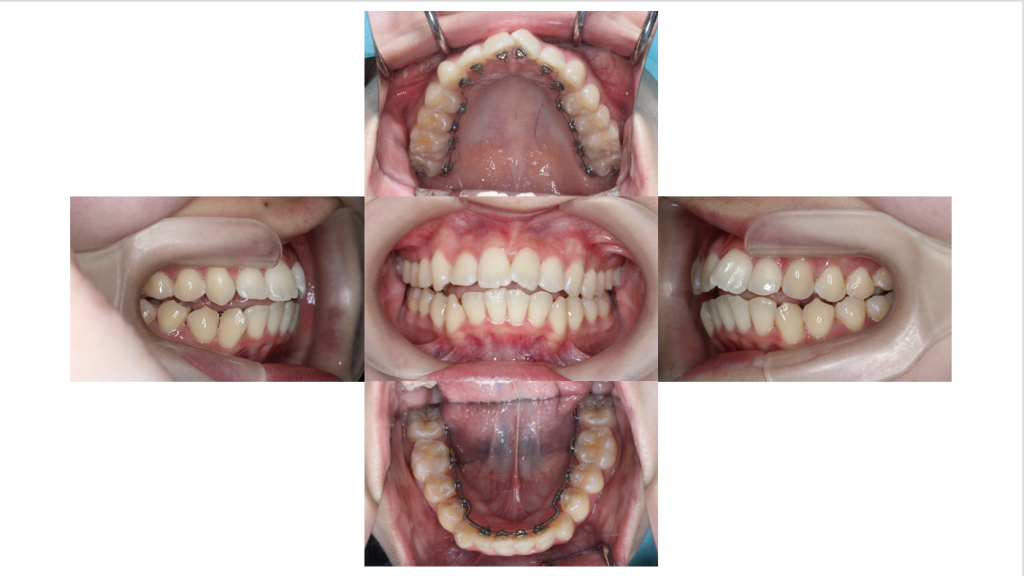 叢生・裏側矯正の症例