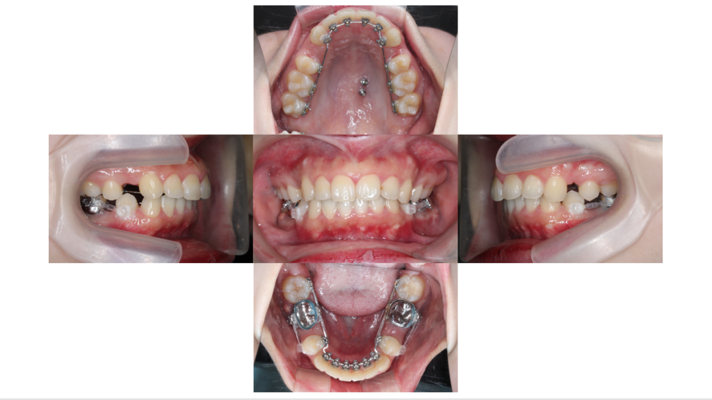 上顎前突・裏側矯正の症例