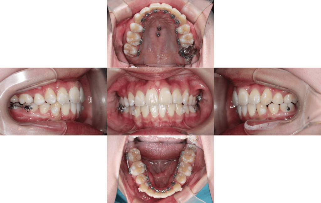 裏側矯正　叢生症例