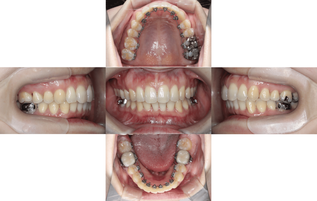 裏側矯正　過蓋咬合症例