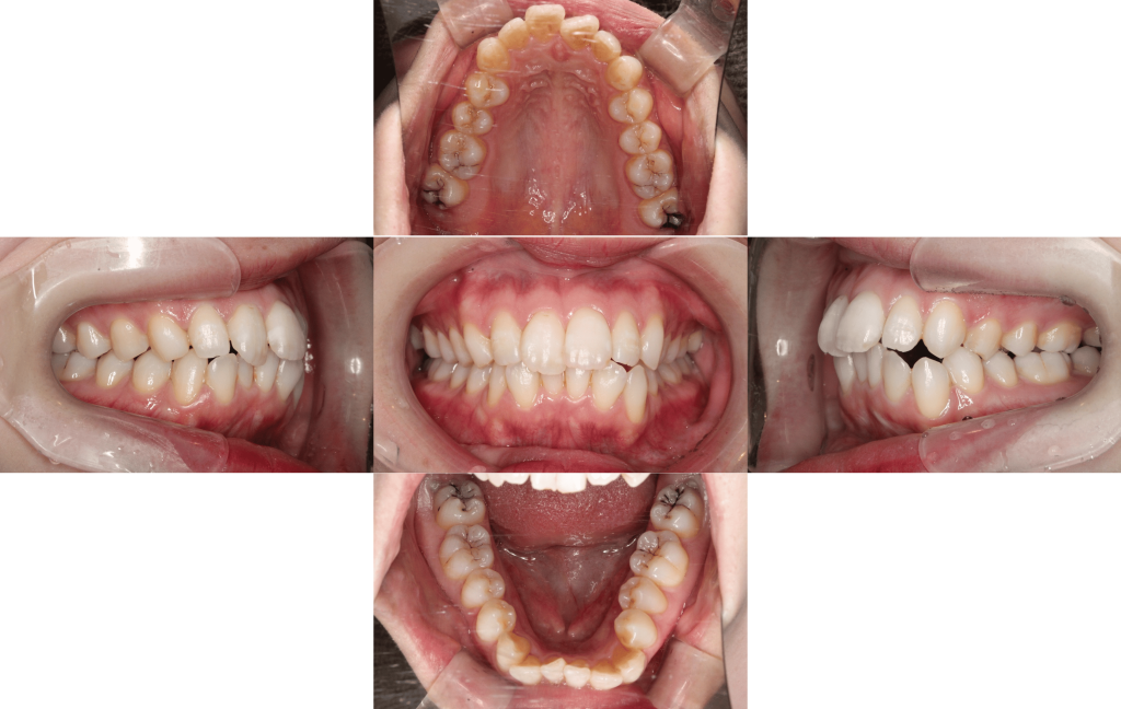 裏側矯正　上下顎前突症例