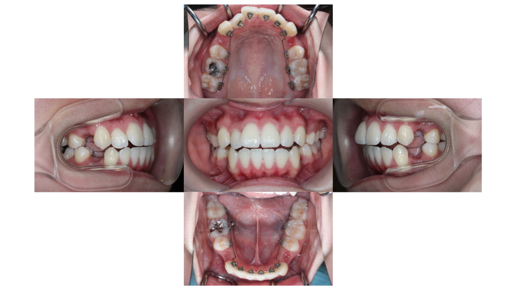叢生・裏側矯正の症例
