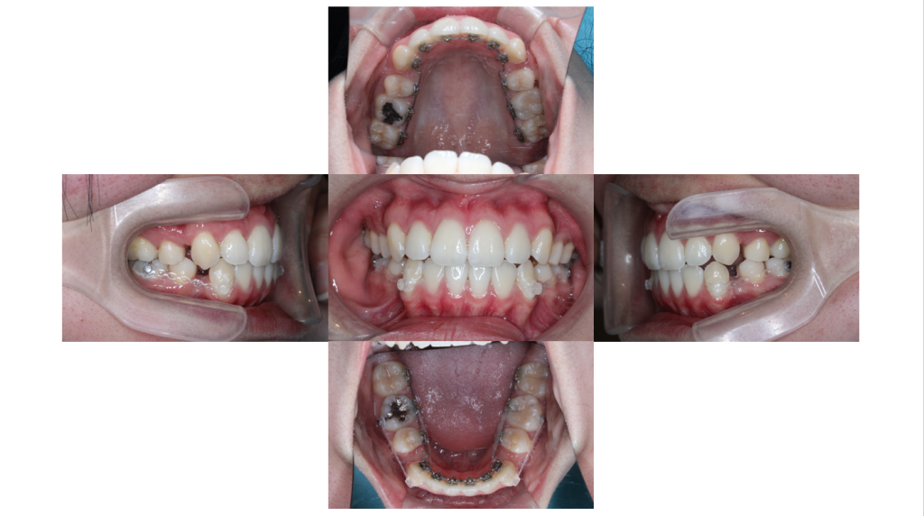 叢生・裏側矯正の症例
