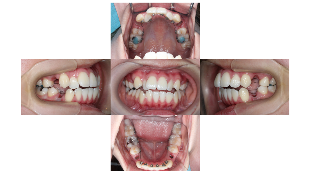 叢生・裏側矯正の症例