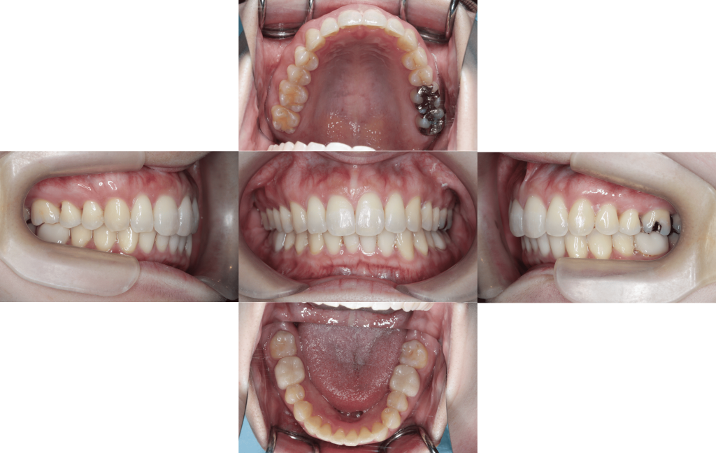 裏側矯正　過蓋咬合症例