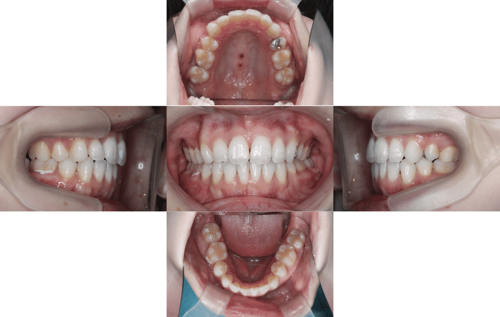 裏側矯正　上下顎前突症例
