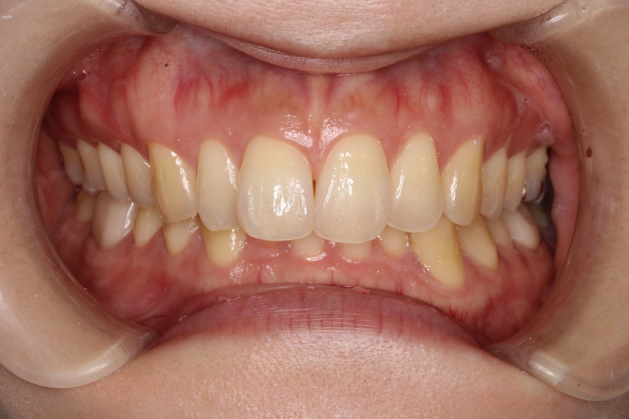 裏側矯正　過蓋咬合症例