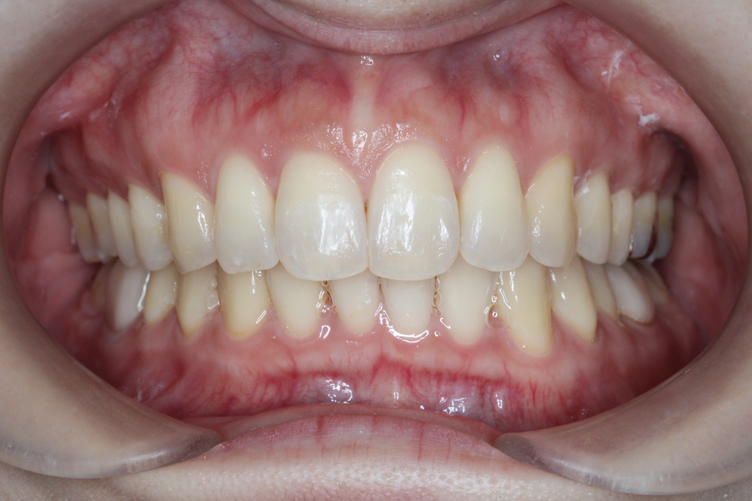 裏側矯正　過蓋咬合症例