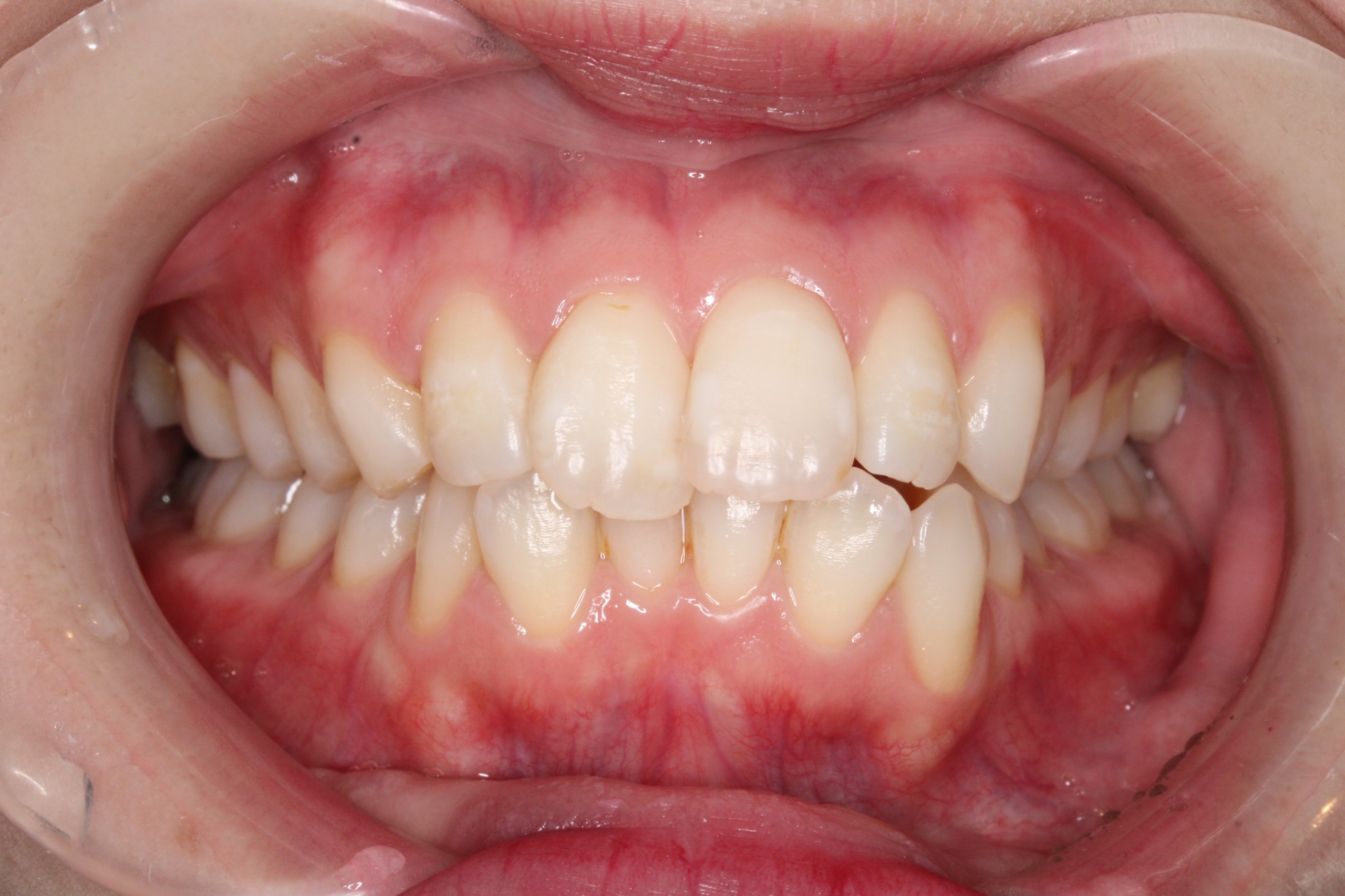 裏側矯正　上下顎前突症例