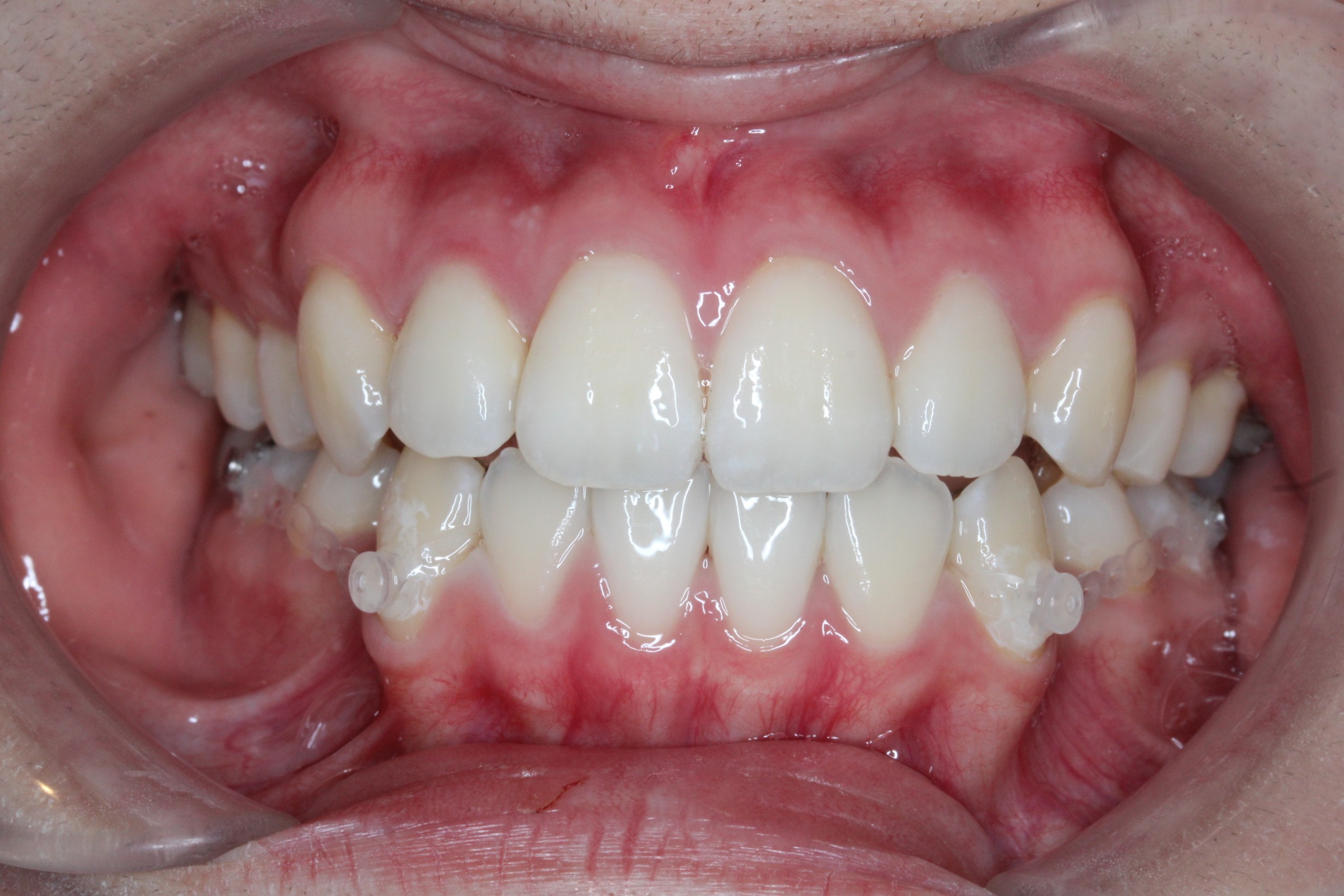 叢生・裏側矯正の症例