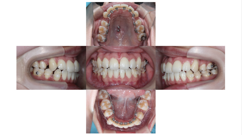 叢生・裏側矯正の症例