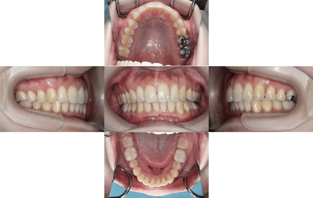 裏側矯正　過蓋咬合症例