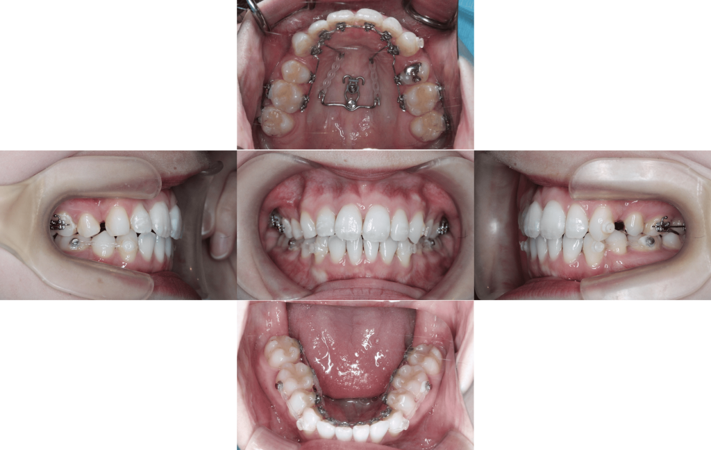 裏側矯正　上下顎前突症例