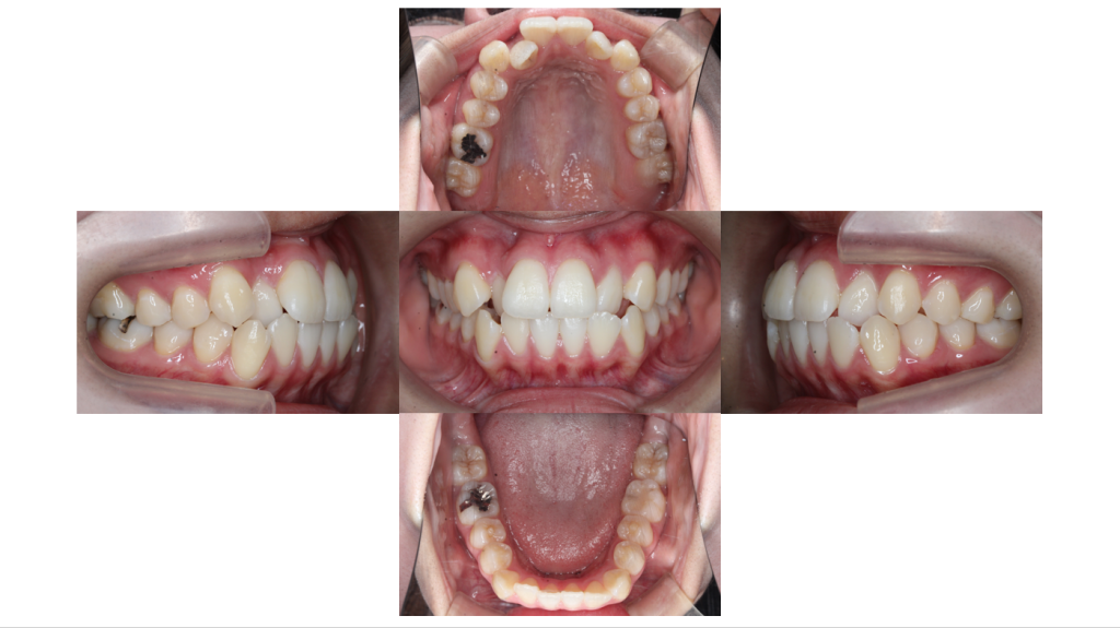 叢生・裏側矯正の症例