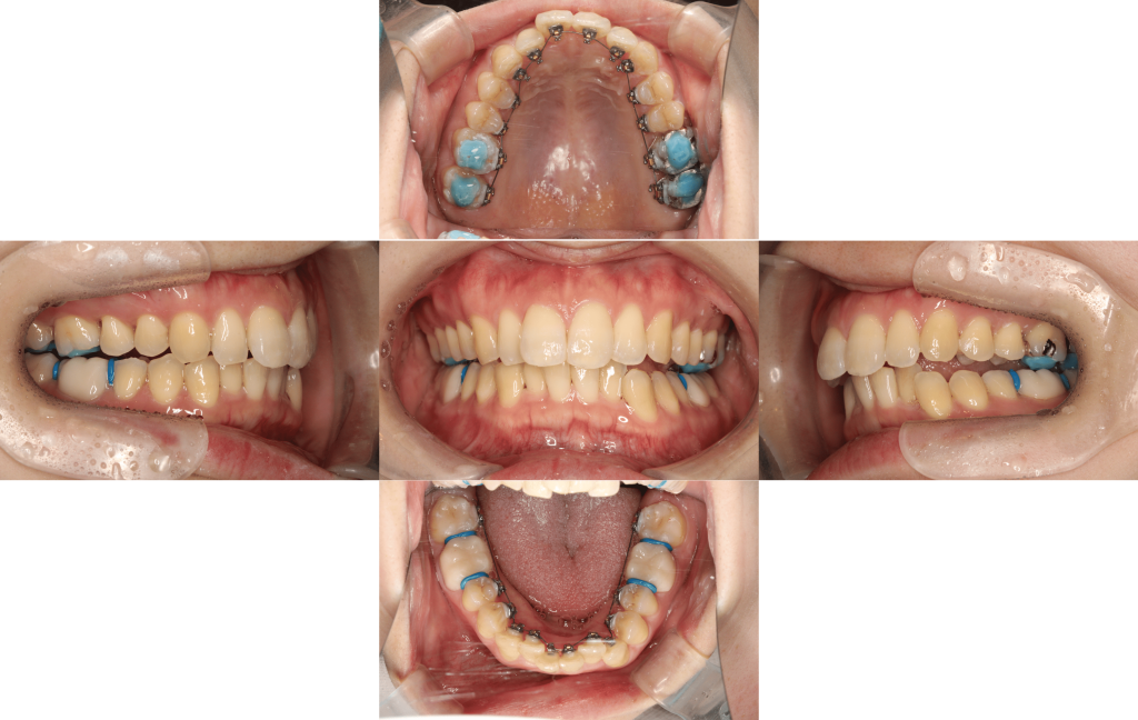 裏側矯正　過蓋咬合症例