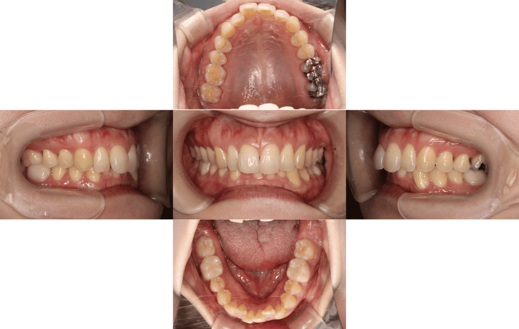 裏側矯正　過蓋咬合症例