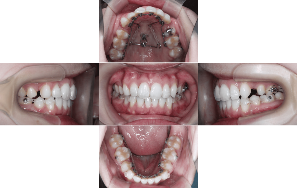 裏側矯正　上下顎前突症例