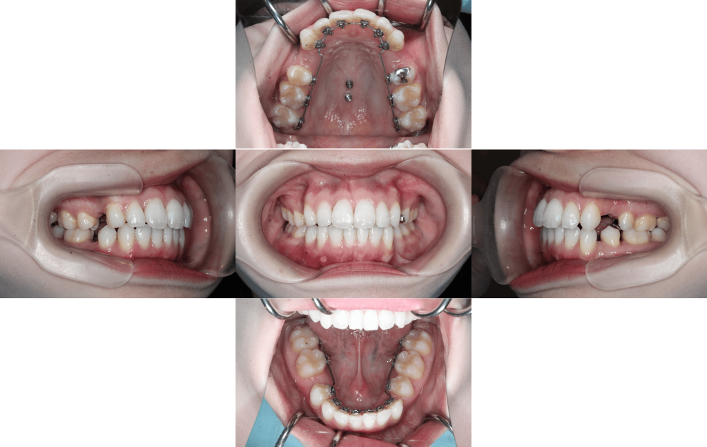 裏側矯正　上下顎前突症例