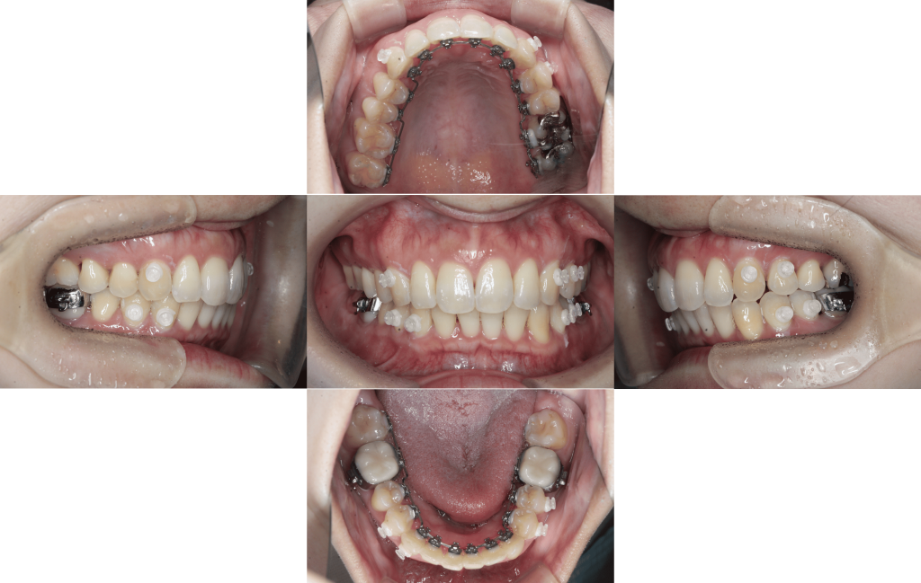 裏側矯正　過蓋咬合症例