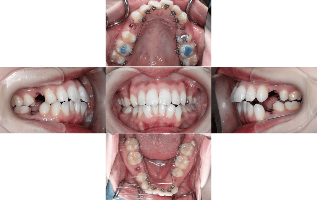 裏側矯正　上下顎前突症例