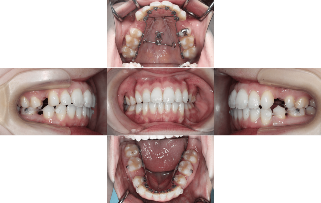 裏側矯正　上下顎前突症例
