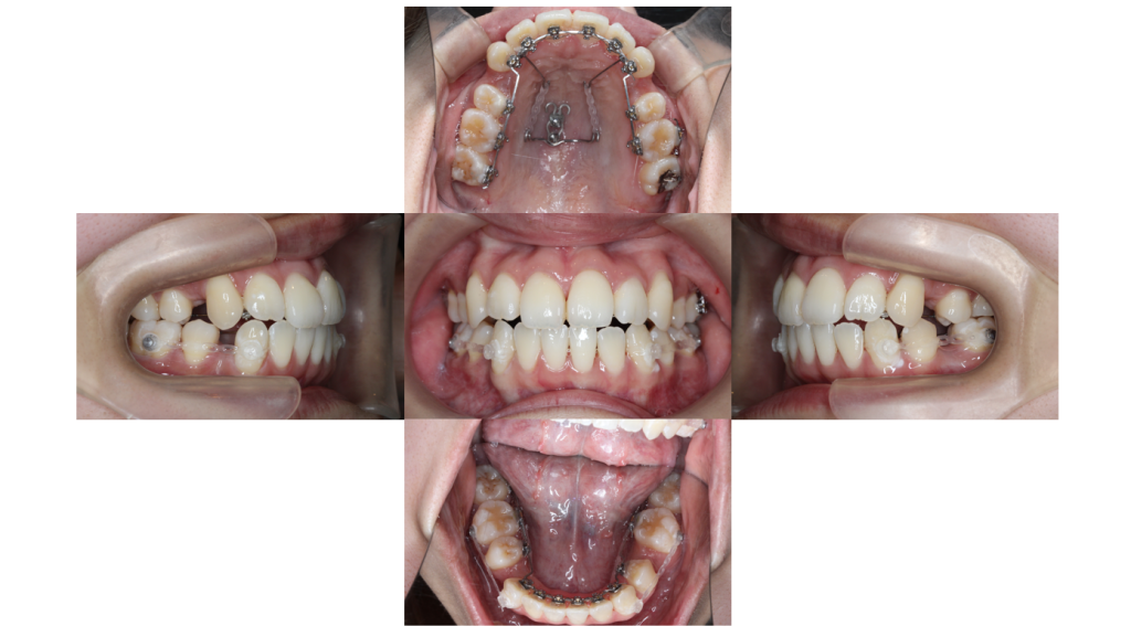 叢生・裏側矯正の症例