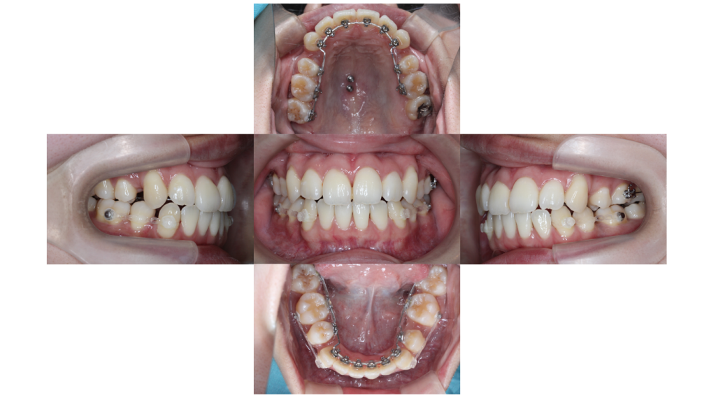 叢生・裏側矯正の症例