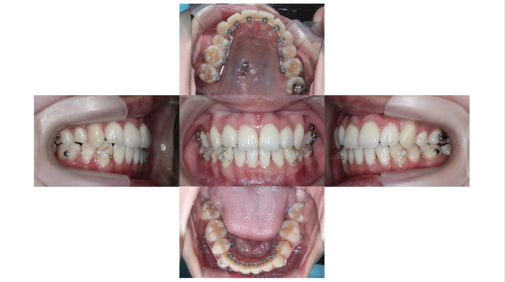 叢生・裏側矯正の症例