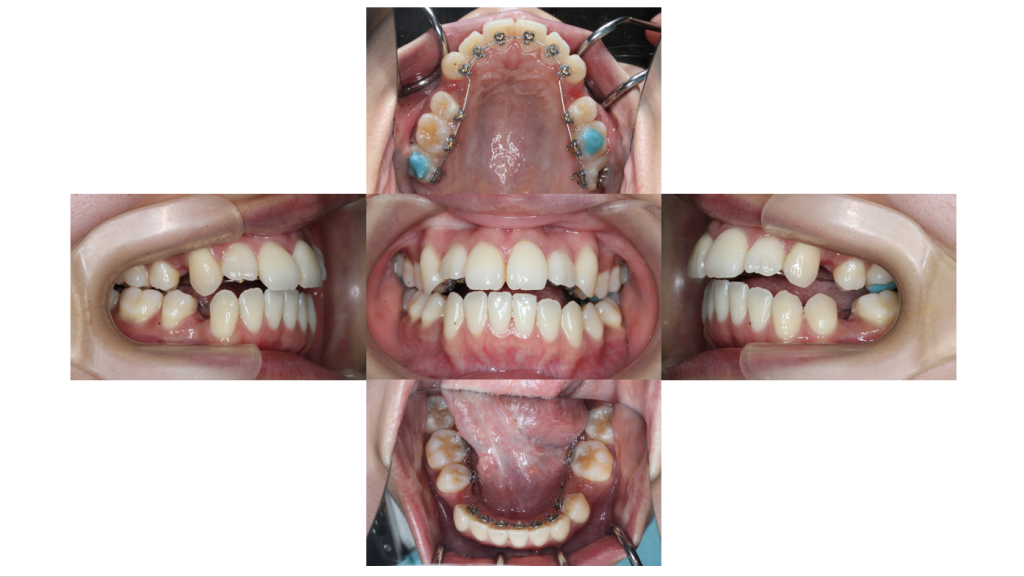 叢生・裏側矯正の症例