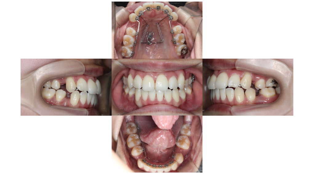 叢生・裏側矯正の症例
